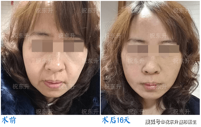 年轻女孩隆鼻手术悲剧背后的深度探究