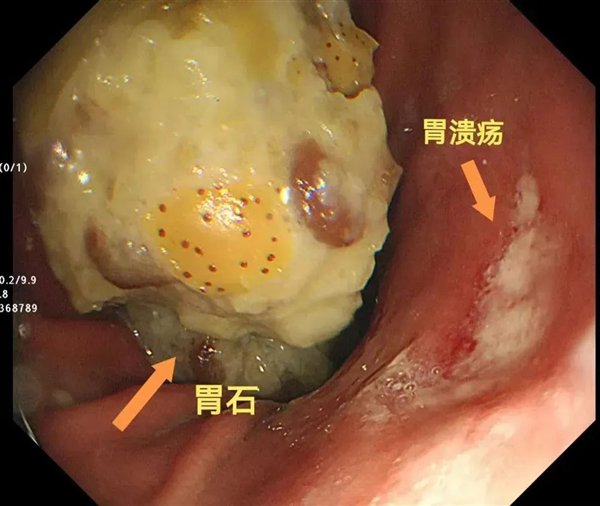 男子贪吃雪花山楂引发胃结石警示公众，贪食零食需警惕健康风险