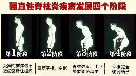 公务员隐瞒强直性脊柱炎，伦理、法律与健康管理的多维探讨