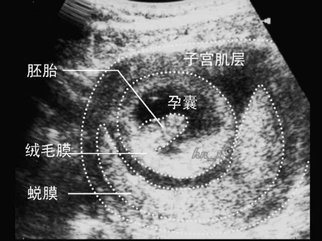 生化妊娠原因探究