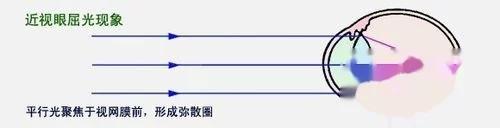 迎太阳闭眼10分钟能否预防近视？——北大人民医院医生的观点及其原理探讨