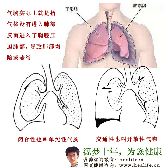 气胸简介，了解气胸及其成因